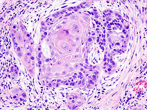 Biopsy of a highly differentiated squamous cel...