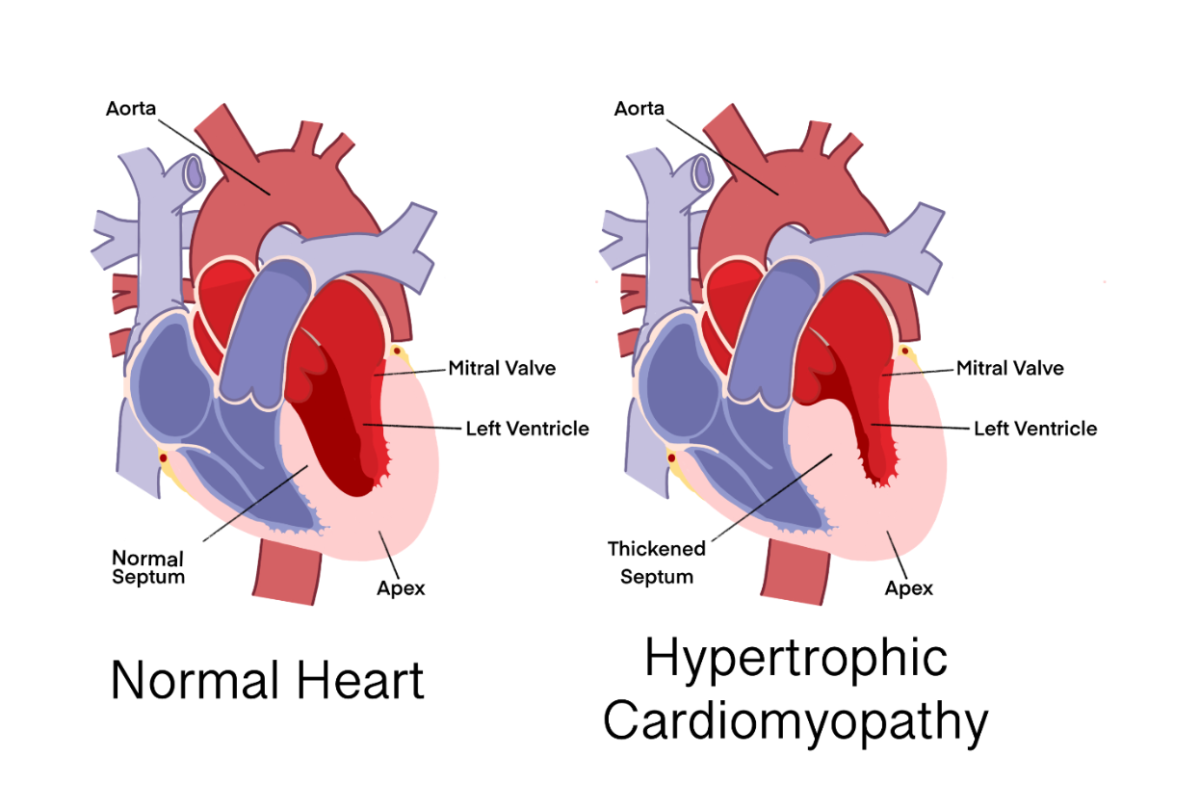 The above graphic compares a normal heart (left) to a heart with hypertrophic cardiomyopathy(right). Mike Papale was inspired to create In a Heartbeat after he had been unexpectedly diagnosed with hypertrophic cardiomyopathy. Graphic by Hannah Salpeter 25. 