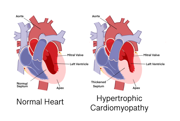 The above graphic compares a normal heart (left) to a heart with hypertrophic cardiomyopathy(right). Mike Papale was inspired to create In a Heartbeat after he had been unexpectedly diagnosed with hypertrophic cardiomyopathy. Graphic by Hannah Salpeter 25. 